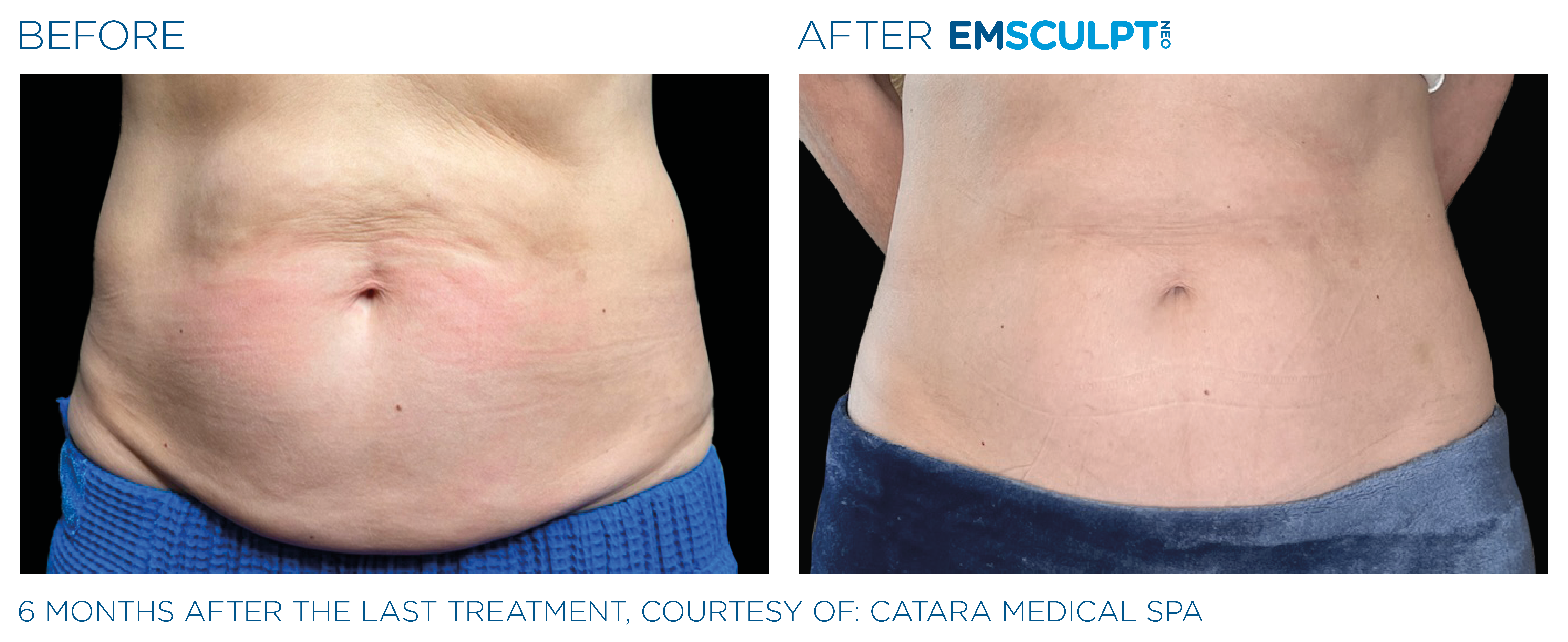 Emsculpt Neo treatments Westlake Village, CA